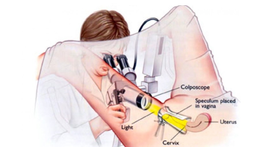 Кольпоскопия это метод исследования: