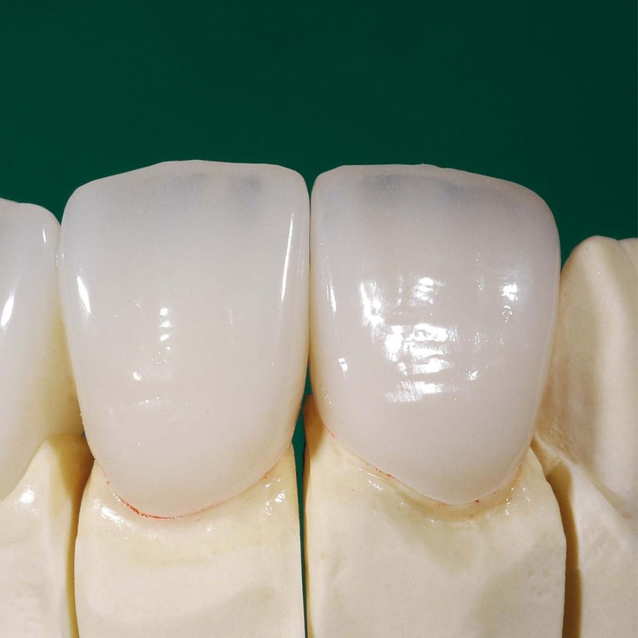 Цельнокерамическая коронка Emax