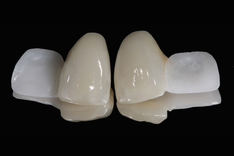 Металлокерамическая коронка CAD/cam