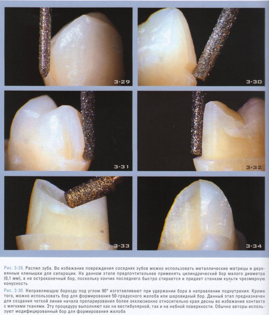 Безметалловая коронка препарирование