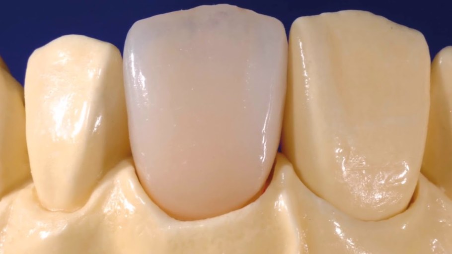 Керамическая коронка Emax