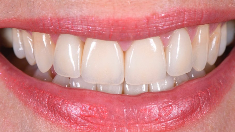 Стеклокерамические коронки