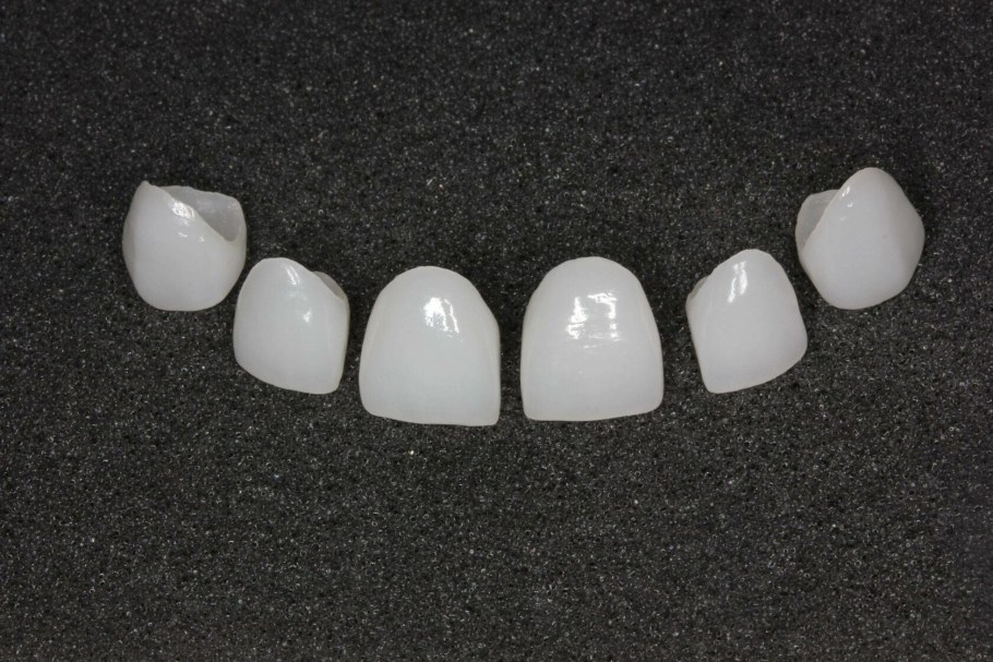 Цельнокерамические виниры e-Max