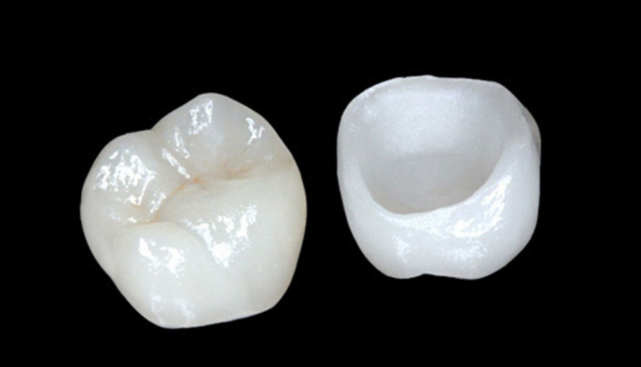 Керамическая e Max Emax вкладка