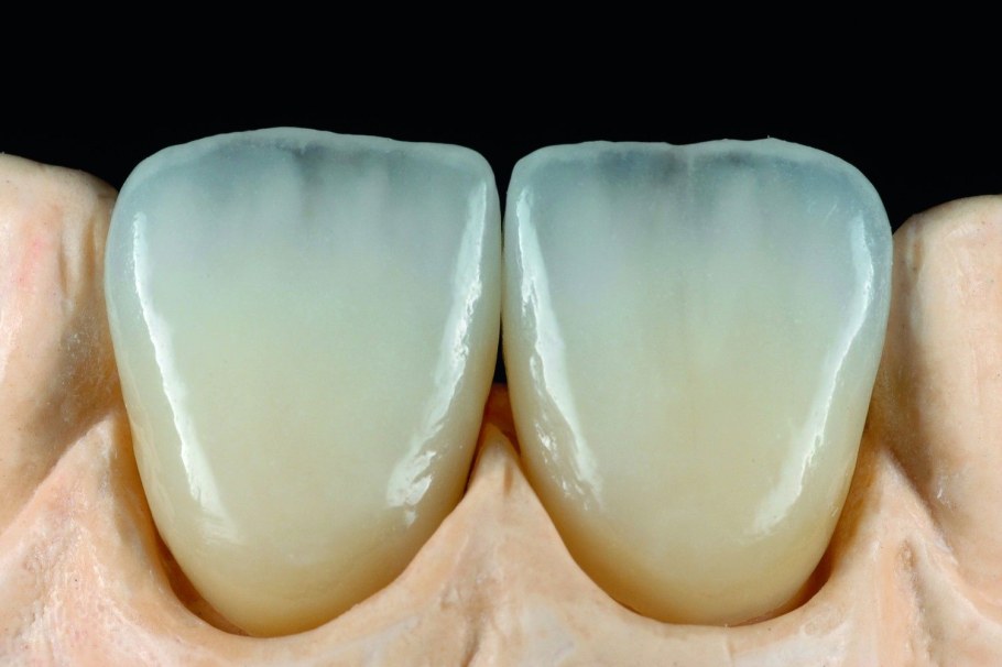 Безметалловая керамика Emax