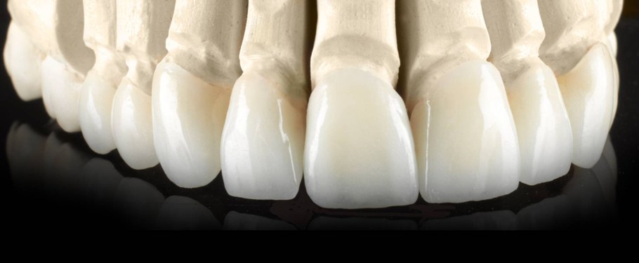 Безметалловая коронка Emax